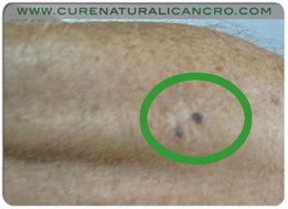 img-melanoma-skin-cancer-iodine-tincture