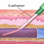 300-catheter